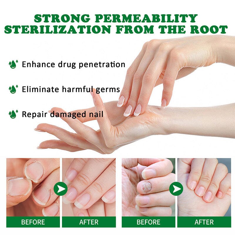 Ginger Nail Essence Fungus Treatment 30ml - Image 5