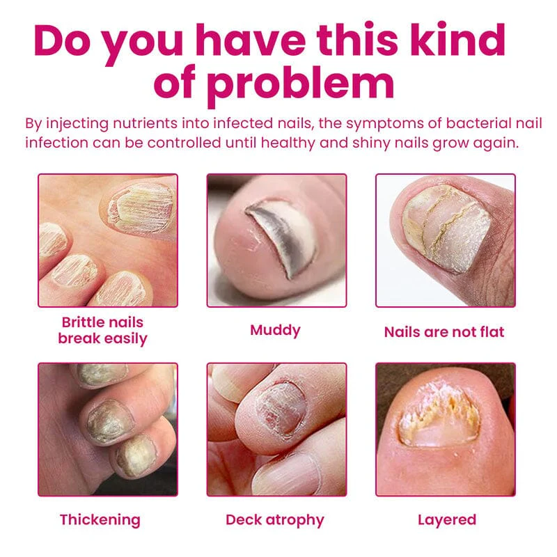 Ginger Nail Essence Repair Fungus Treatment 10ml - Image 5