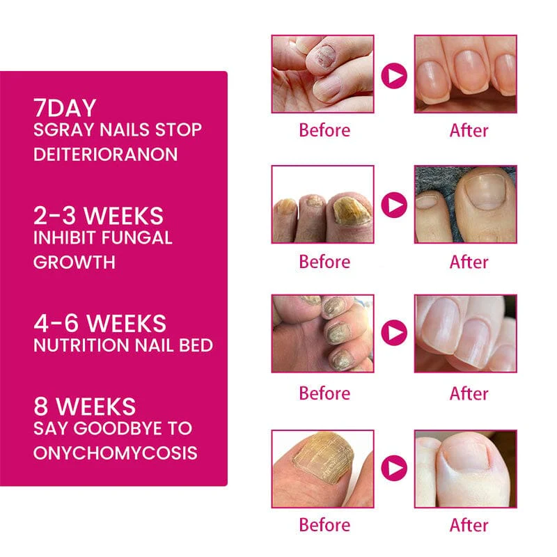 Ginger Nail Essence Repair Fungus Treatment 10ml - Image 6